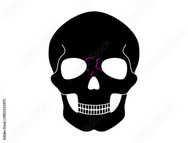 Obraz Nasal fracture poster