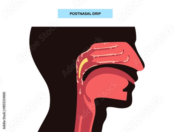 Obraz Postnasal drip poster