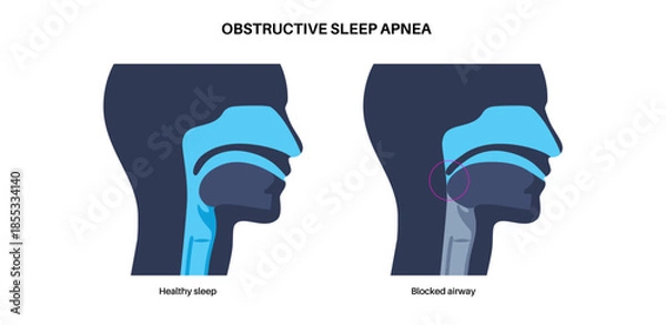 Obraz Obstructive sleep apnea