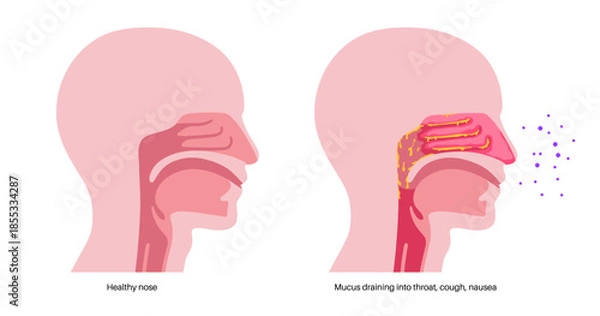 Obraz Postnasal drip poster