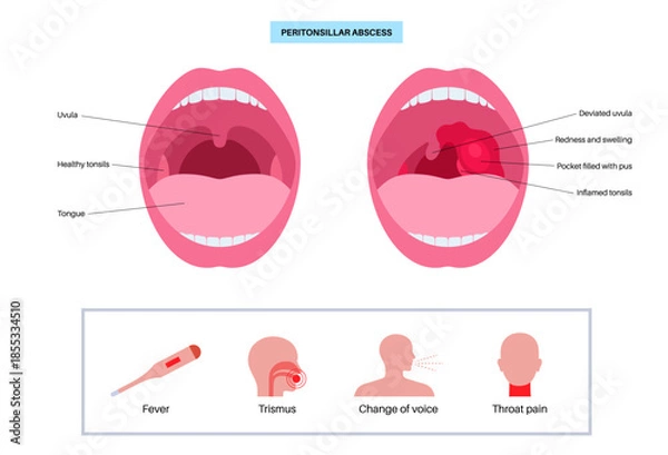 Obraz Peritonsillar abscess poster