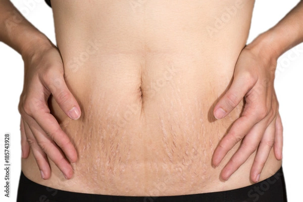 Obraz Woman belly fat pattern