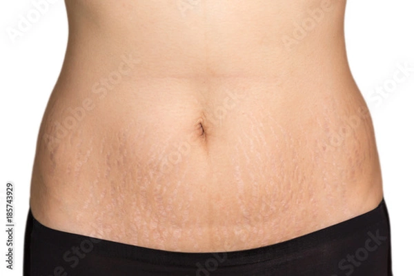 Obraz Woman belly fat pattern