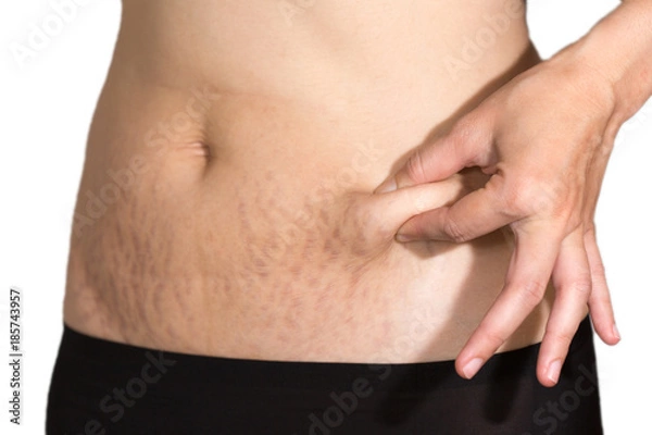 Obraz Woman belly fat pattern