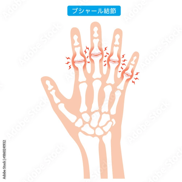 Obraz ブシャール結節　指の関節の病気