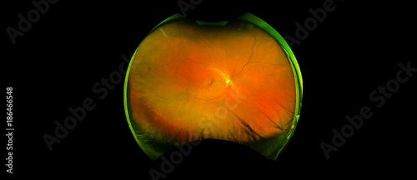 Obraz eye's retinal angle image with macula, vessels and optic disc isolated view on a black bacground. made by ultra wide fundus camera