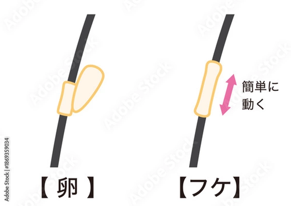 Obraz アタマジラミの卵とフケの見分け方