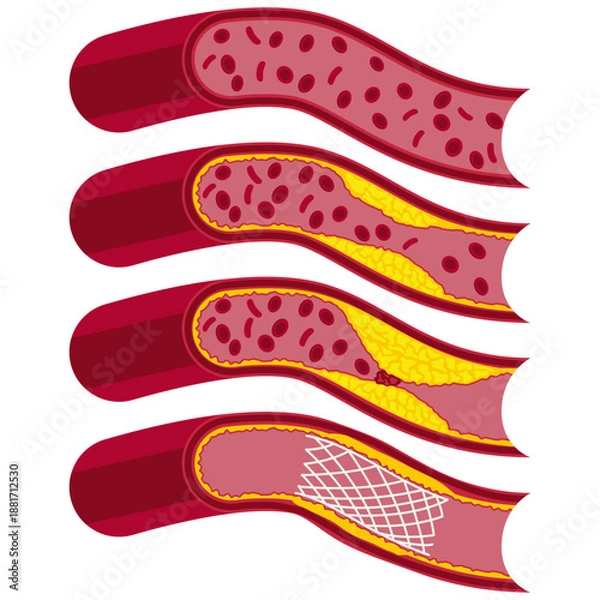 Obraz blocked blood vessel vector drawing.