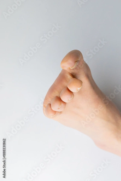 Obraz 巻き爪・陥入爪の症状が出ている足の爪