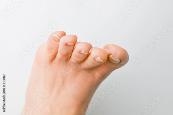 Obraz 巻き爪・陥入爪の症状が出ている足の爪