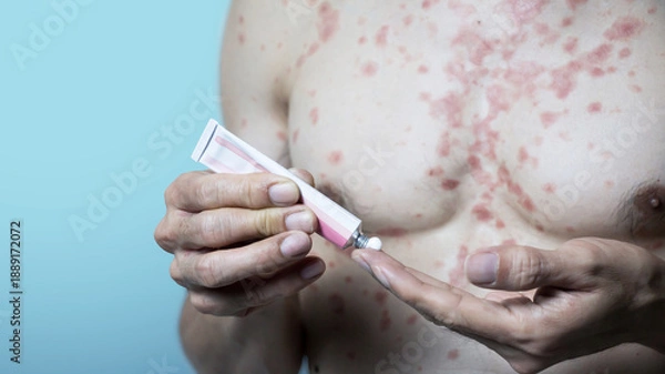 Fototapeta Itchy rash