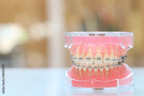 Obraz 歯科矯正模型