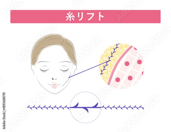 Obraz 糸リフト