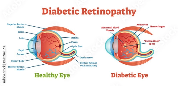 Fototapeta Diabetic Retinopathy vector illustration diagram, anatomical scheme. 