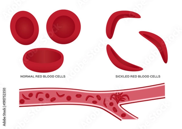 Fototapeta Normal red blood cell and sickle cell vector