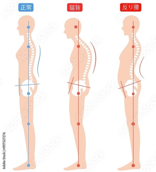 Obraz 正しい姿勢と猫背と反り腰の女性　背骨と骨盤
