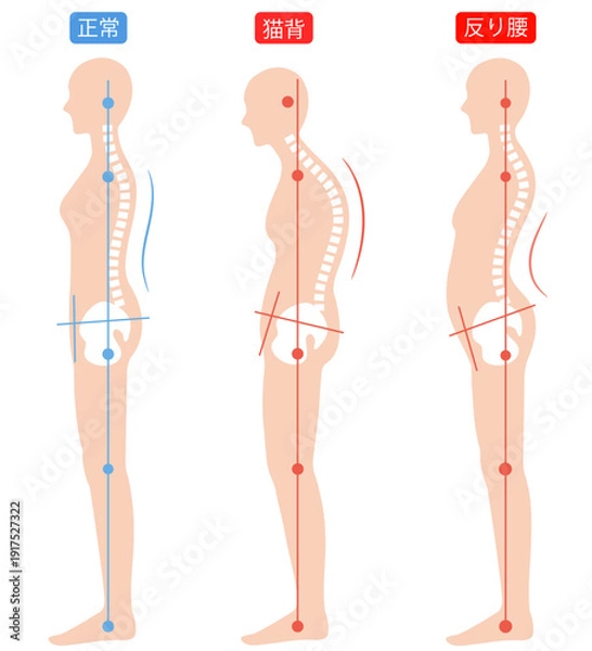 Obraz 正しい姿勢と猫背と反り腰の女性　背骨と骨盤