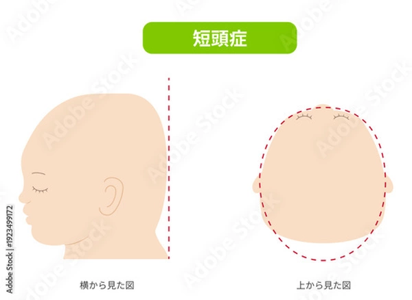 Obraz 横と真上から見た頭の形に歪みがある斜頭症,短頭症,長頭症の赤ちゃんのイラスト