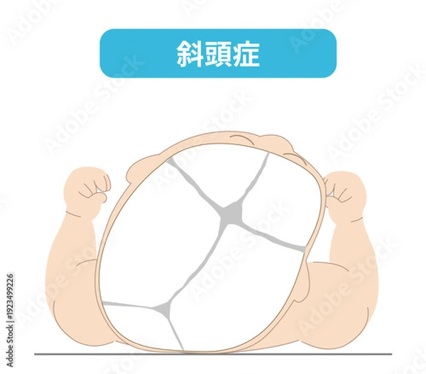 Obraz 赤ちゃんが寝ている頭の向きによって頭の形に歪みが生じるメカニズム、斜頭症,短頭症,長頭症の赤ちゃんのイラスト