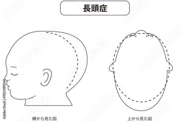 Obraz 白黒線画　横と真上から見た頭の形に歪みがある斜頭症,短頭症,長頭症の赤ちゃんのイラスト