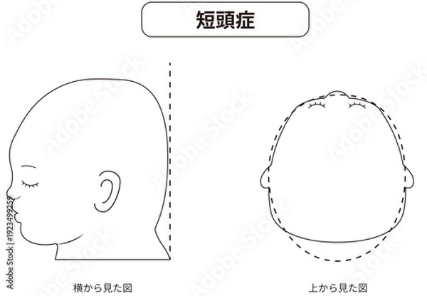 Obraz 白黒線画　横と真上から見た頭の形に歪みがある斜頭症,短頭症,長頭症の赤ちゃんのイラスト