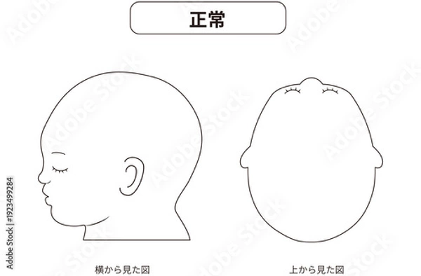 Obraz 白黒線画　横と真上から見た頭の形が正常な赤ちゃんのイラスト　斜頭症,短頭症,長頭症との比較