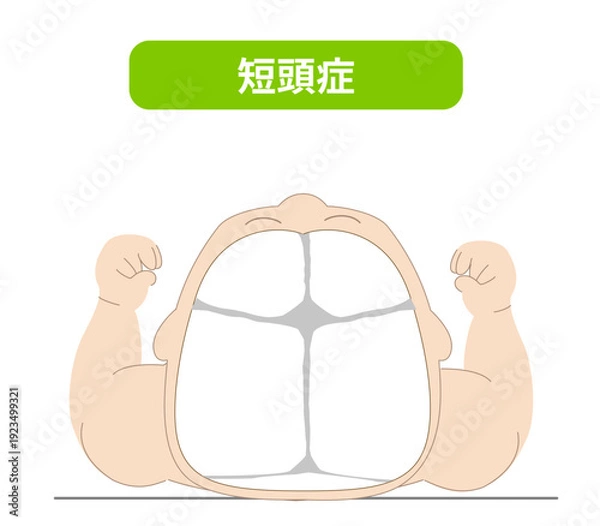 Obraz 赤ちゃんが寝ている頭の向きによって頭の形に歪みが生じるメカニズム、斜頭症,短頭症,長頭症の赤ちゃんのイラスト