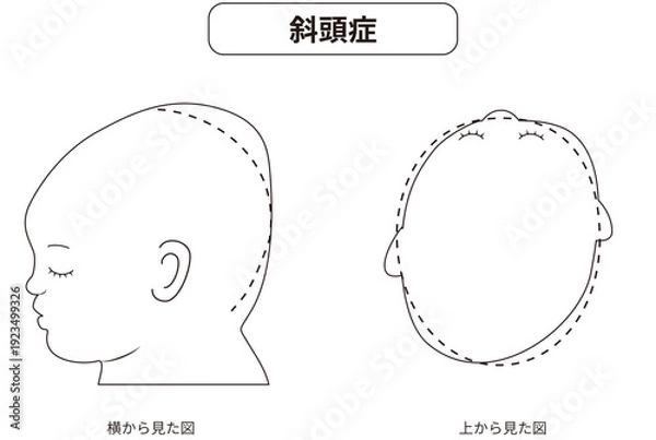 Obraz 白黒線画　横と真上から見た頭の形に歪みがある斜頭症,短頭症,長頭症の赤ちゃんのイラスト