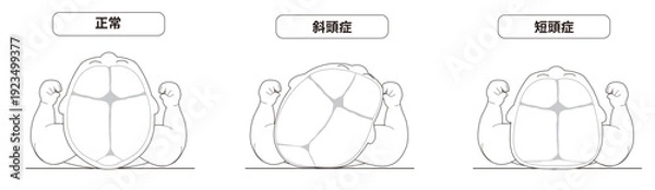 Obraz 白黒線画　赤ちゃんが寝ている頭の向きによって頭の形に歪みが生じるメカニズム、斜頭症,短頭症,長頭症の赤ちゃんのイラスト