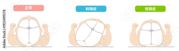 Obraz 赤ちゃんが寝ている頭の向きによって頭の形に歪みが生じるメカニズム、斜頭症,短頭症,長頭症の赤ちゃんのイラスト