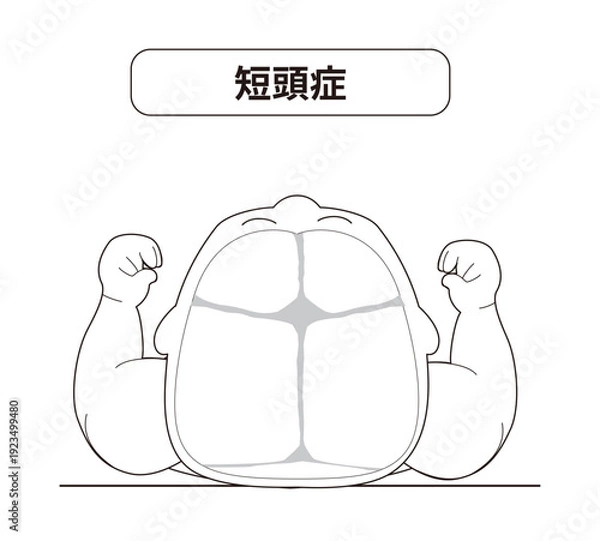 Obraz 赤ちゃんが寝ている頭の向きによって頭の形に歪みが生じるメカニズム、斜頭症,短頭症,長頭症の赤ちゃんのイラスト