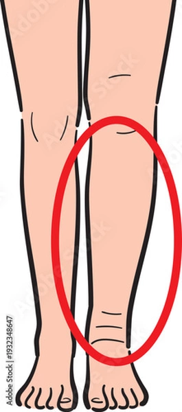 Obraz 片方だけが浮腫んでいる脚