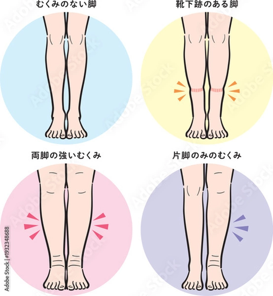 Obraz 脚のむくみの種類セット