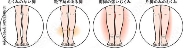 Obraz 脚のむくみの症状比較（靴下跡・両脚むくみ・片脚のみ）