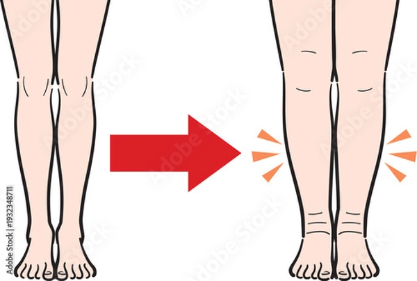 Obraz むくみのない脚からむくみのある脚への変化