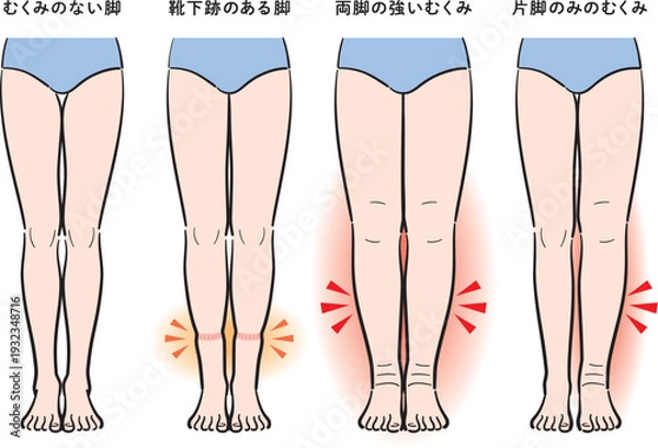 Obraz 脚のむくみの症状比較（靴下跡・両脚むくみ・片脚のみ）