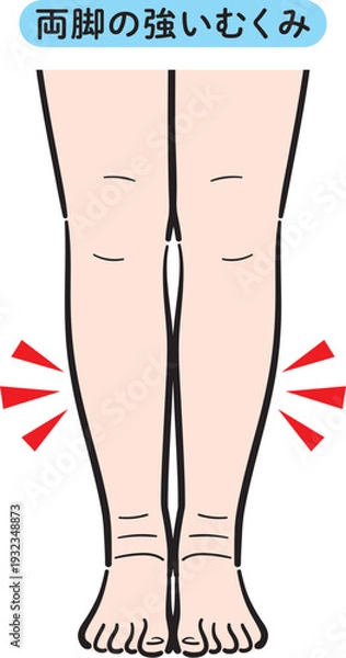 Obraz 両脚の強いむくみ