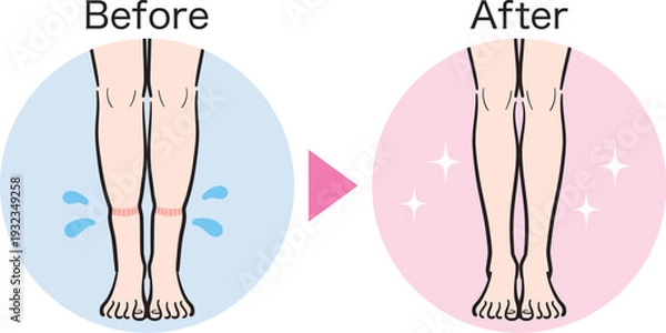 Obraz 脚の軽度むくみ（靴下跡）のビフォーアフター