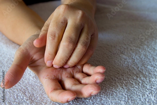 Fototapeta Eczema on the hands . Skin disease causing itching . Woman's hands scratching with eczema