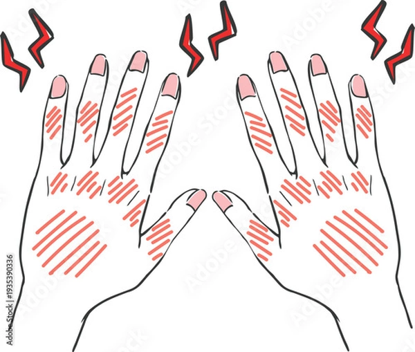 Obraz ハンドケア　手荒れ　トラブルのある手　ベクター