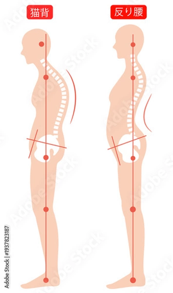 Obraz 猫背と反り腰　背骨と骨盤