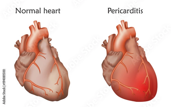Fototapeta Pericarditis. Inflammation of the pericardium. Damaged and normal heart muscles. Anatomy illustration. Colorful image, white background.