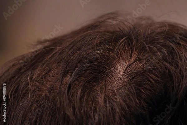 Obraz 中年男性の頭頂部の薄毛と頭皮の状態