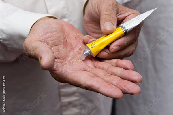 Fototapeta Ointment on the hands of an elderly person. Applying the ointment and emollient cream in the treatment and hydration of the skin . Problem skin in old age