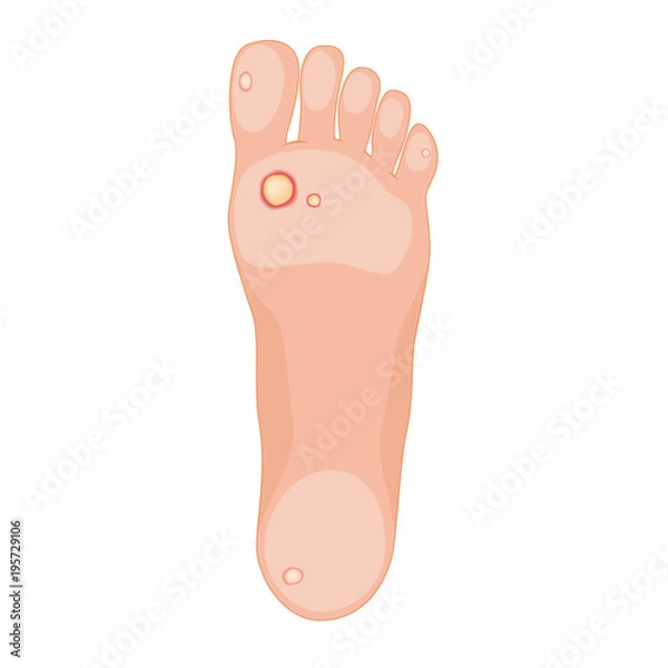 Fototapeta foot impact point vector callus