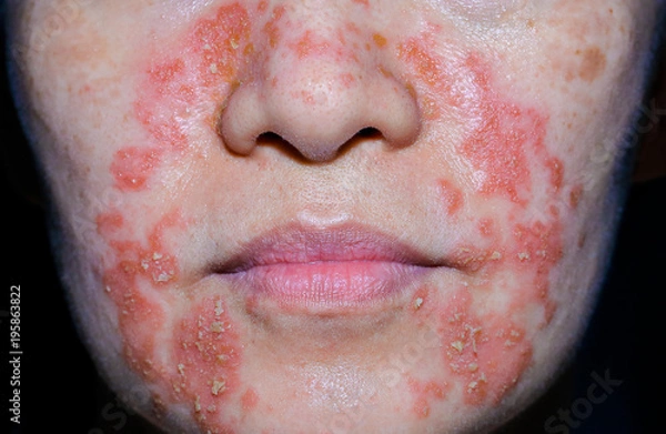 Fototapeta Seborrheic Dermatitis face