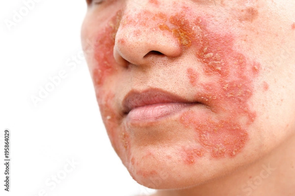Fototapeta Seborrheic Dermatitis face