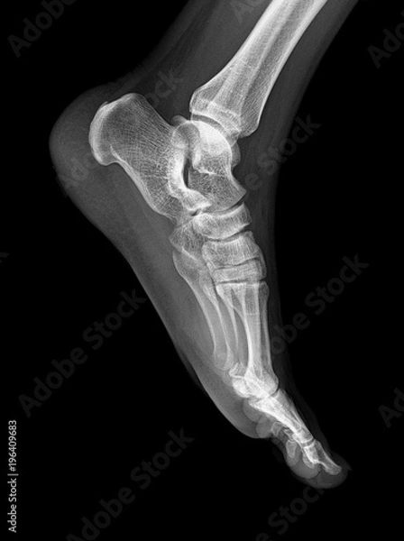 Obraz Deformed feet - pes planus