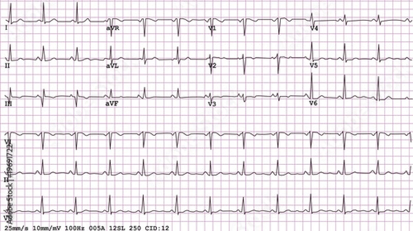 Fototapeta Example of a normal 12-lead sinus rhythm ECG