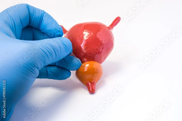 Fototapeta Prostate gland tissue biopsy procedure. Urologist holding needle and makes body puncture of anatomical prostate organ. Obtaining samples of prostate tissue for diagnostic manipulations for diagnostics